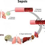 Sepsis, bacteremia and the risk of septic shock (life-threatening low blood pressure)