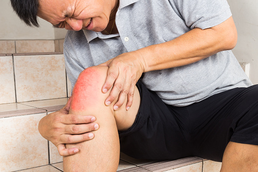 Gout in knee: Causes, symptoms, ...