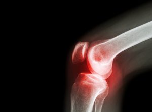 what causes septic arthritis