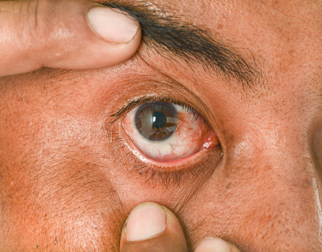 Eyeball spots: Causes, symptoms,...