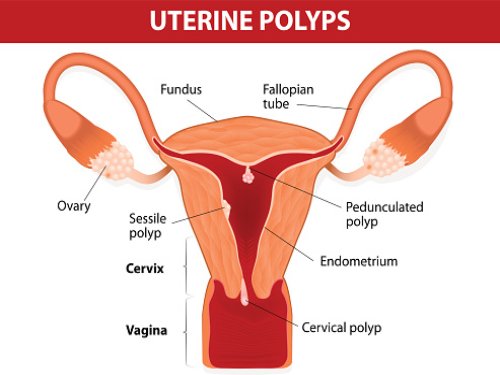 Uterine polyps (endometrial poly...