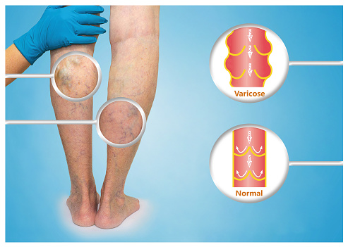 Signs you’re suffering from vari...