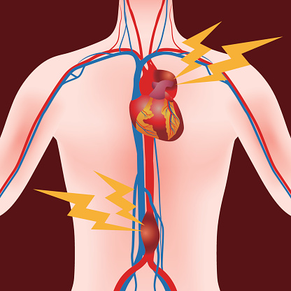 Common causes of aortic regurgit...