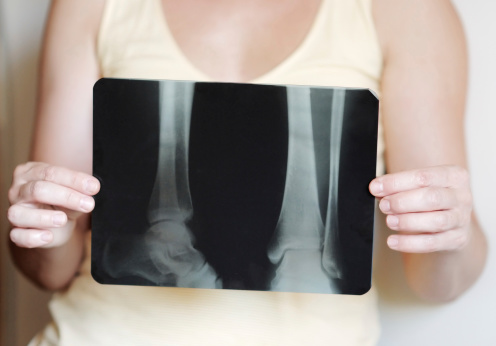 9 tips to prevent bone loss