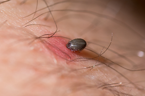 Lyme disease tests see advanceme...