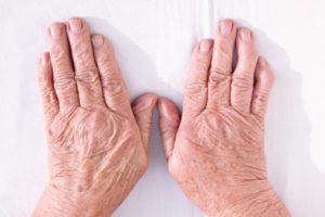 Rheumatoid arthritis update 2017...