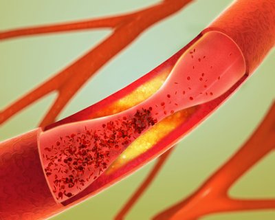 Iliac artery aneurysm: Types, ca...