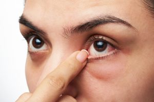 Age-related macular degeneration...