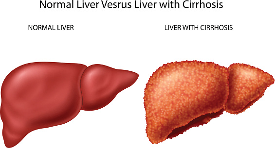 Your liver is in trouble and you...