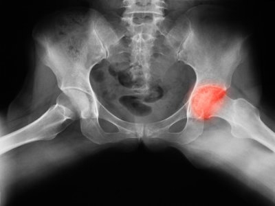 Hip osteonecrosis