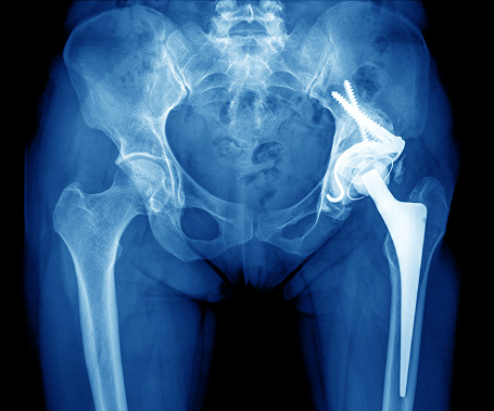Your risk of a bone fracture goe...