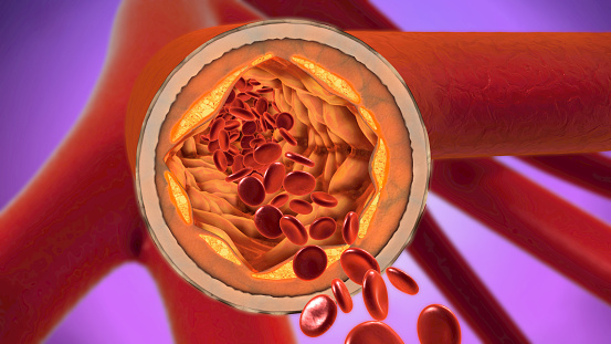 Hardening of the arteries or art...