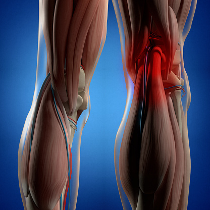 What causes calcific tendinitis?...