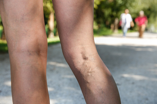 Chronic venous insufficiency: Ca...