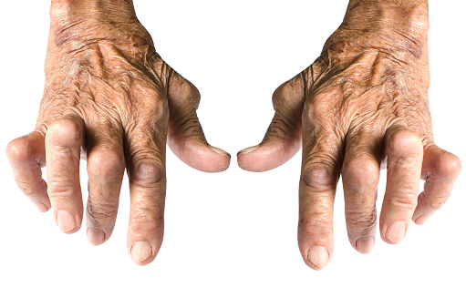 Rheumatoid arthritis found to wo...