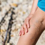 painful veins and how to get rid of it