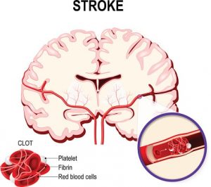 ischemic vs hemorrhagic stroke