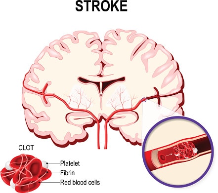 Ischemic vs Hemorrhagic Stroke: ...