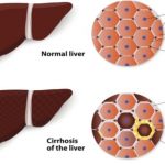 fibrosis leading cause of liver cirrhosis