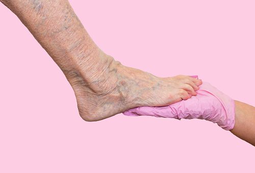 Varicose Veins Linked with Higher Risk of Deep Venous Thrombosis
