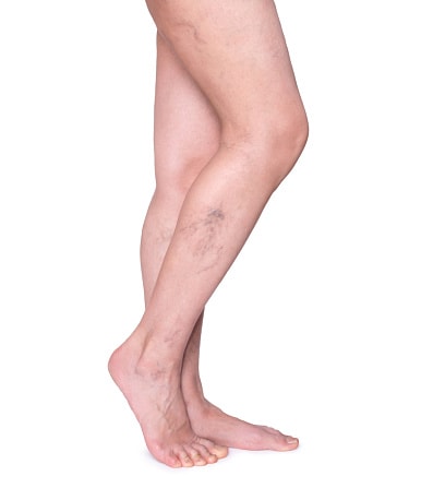 Poor Circulation in Legs: Causes...