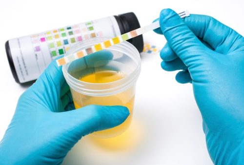 Des leucocytes peuvent parfois apparaître dans les tests d'urine.