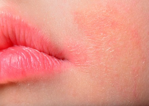Severe Atopic Eczema Increases C...
