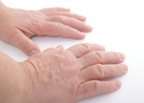 Common Causes of Swollen Hands