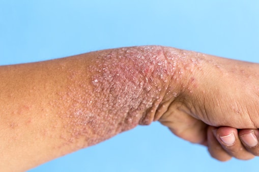This Skin Condition Could Mean T...