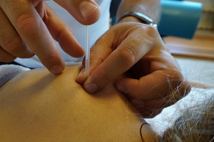 What Is Dry Needling, and Should...