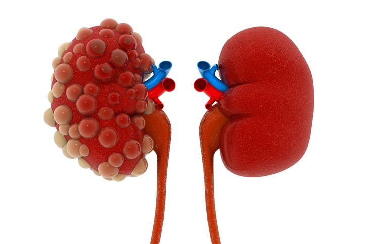 End-Stage Renal Disease (ESRD) I...