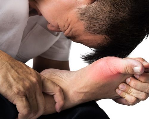 Gout associated with increased risk