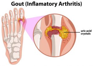 Gout doubles the risk of atrial