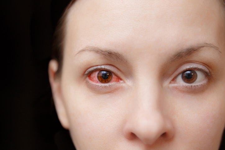 Ocular Rosacea: Causes, Symptoms...