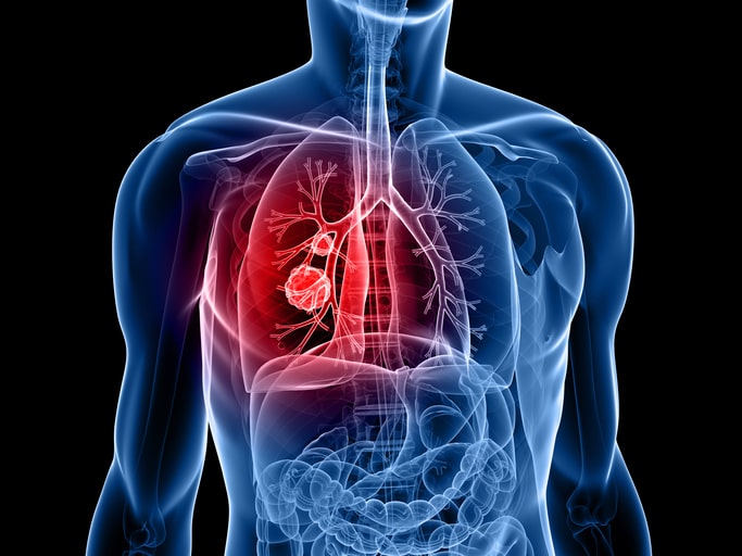Midlife Lung Disease Is Linked w...