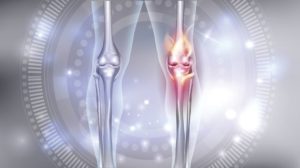 knee osteoarthritis massage