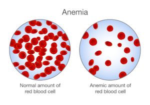 tinnitus anemia