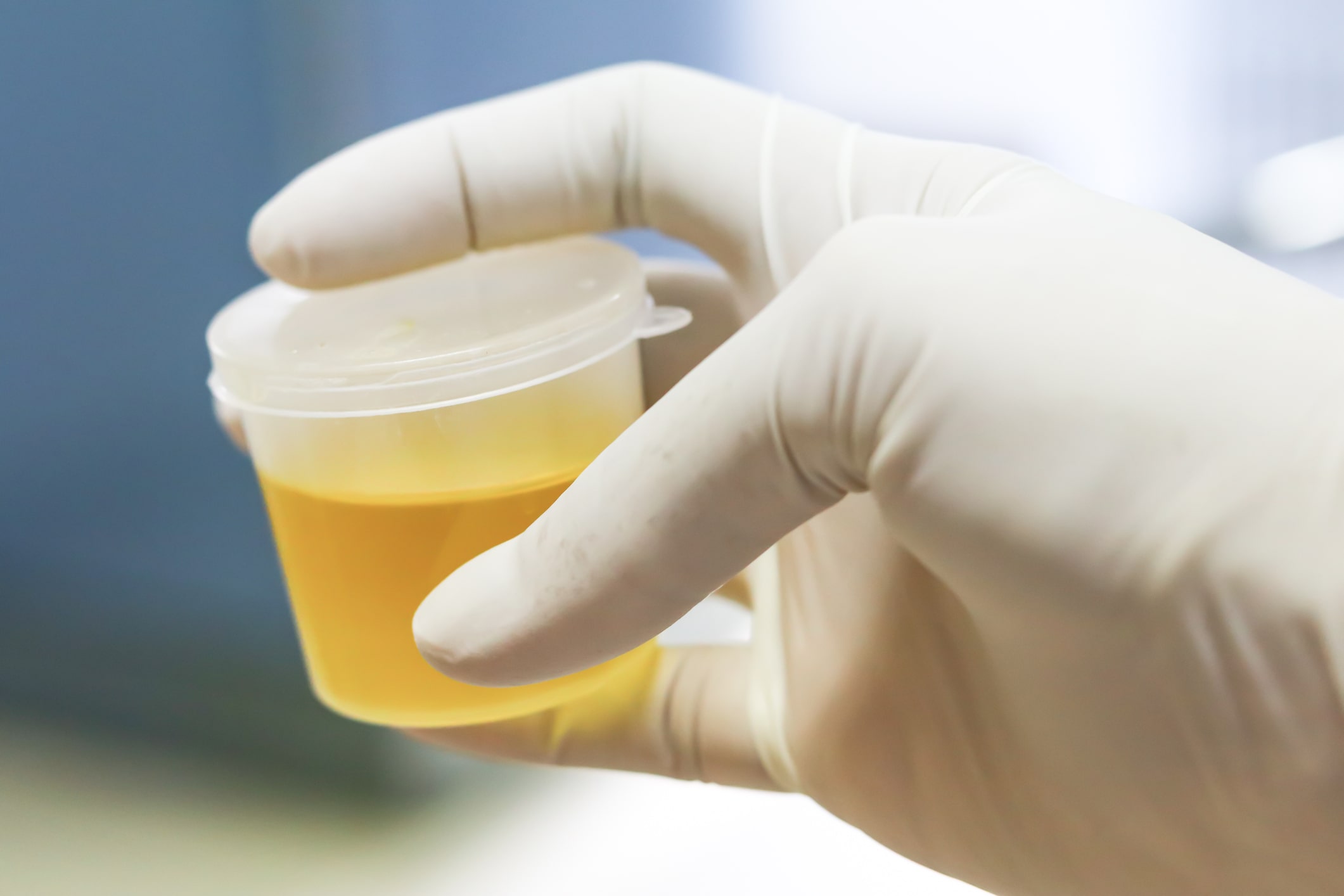 New urine test may help diagnose...