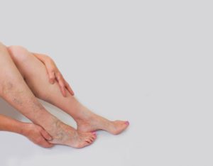 Why varicose veins cause a health problem