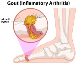 gout, diabetes and stroke