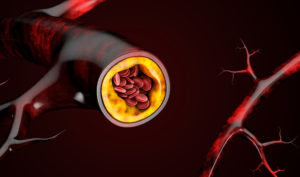 3d Illustration of blood cells with plaque buildup of cholesterol.
