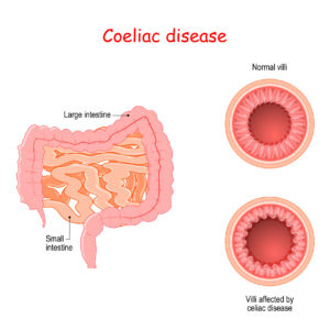 Coeliac disease. normal and villous atrophy. small and large intestines. Cross section of small bowel. Healthy and Villi affected by celiac disease