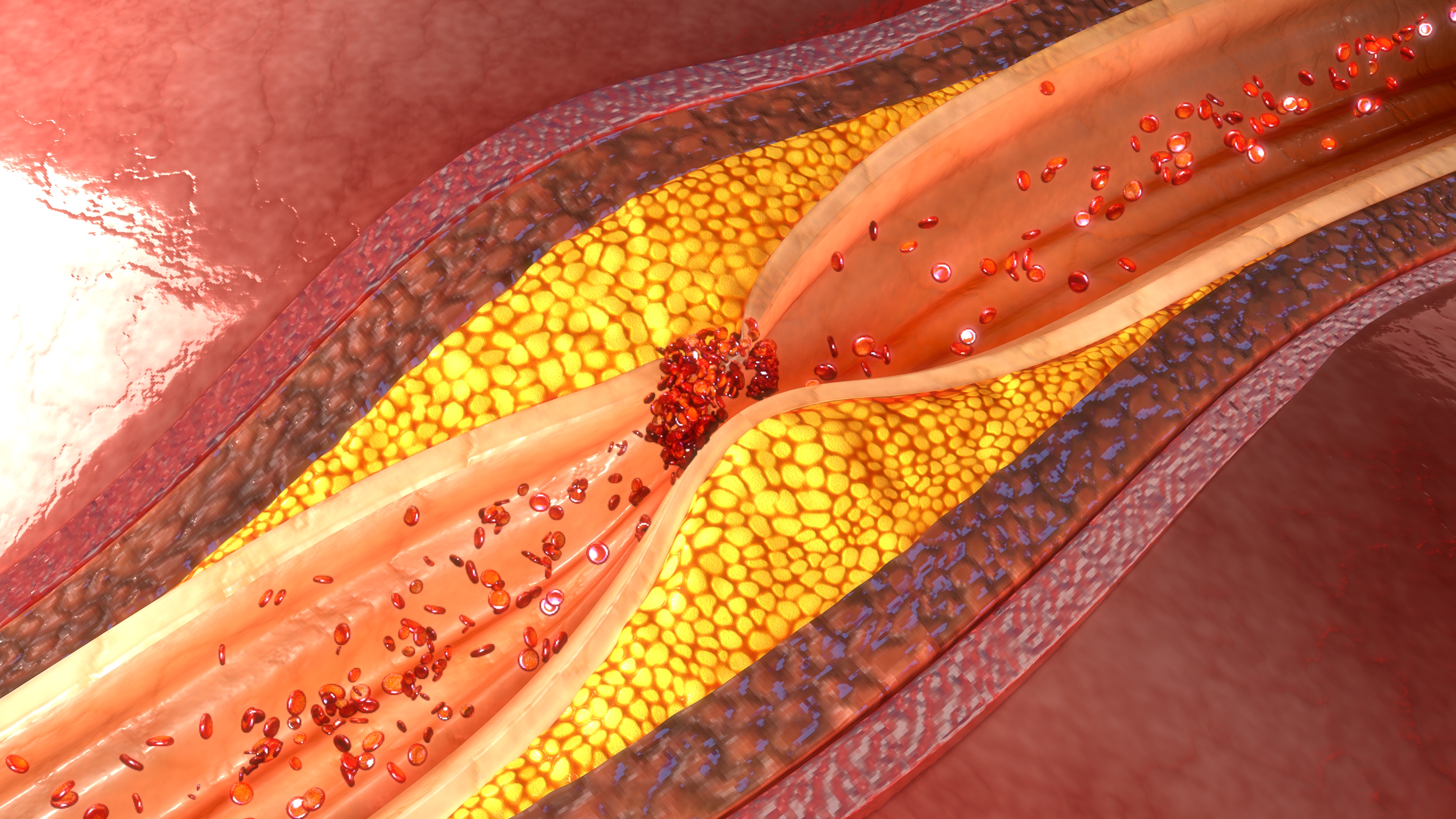 Patients with PAD or Stroke Are ...