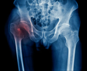 x-ray hip fracture of old man, x-ray image intertrochanteric fracture