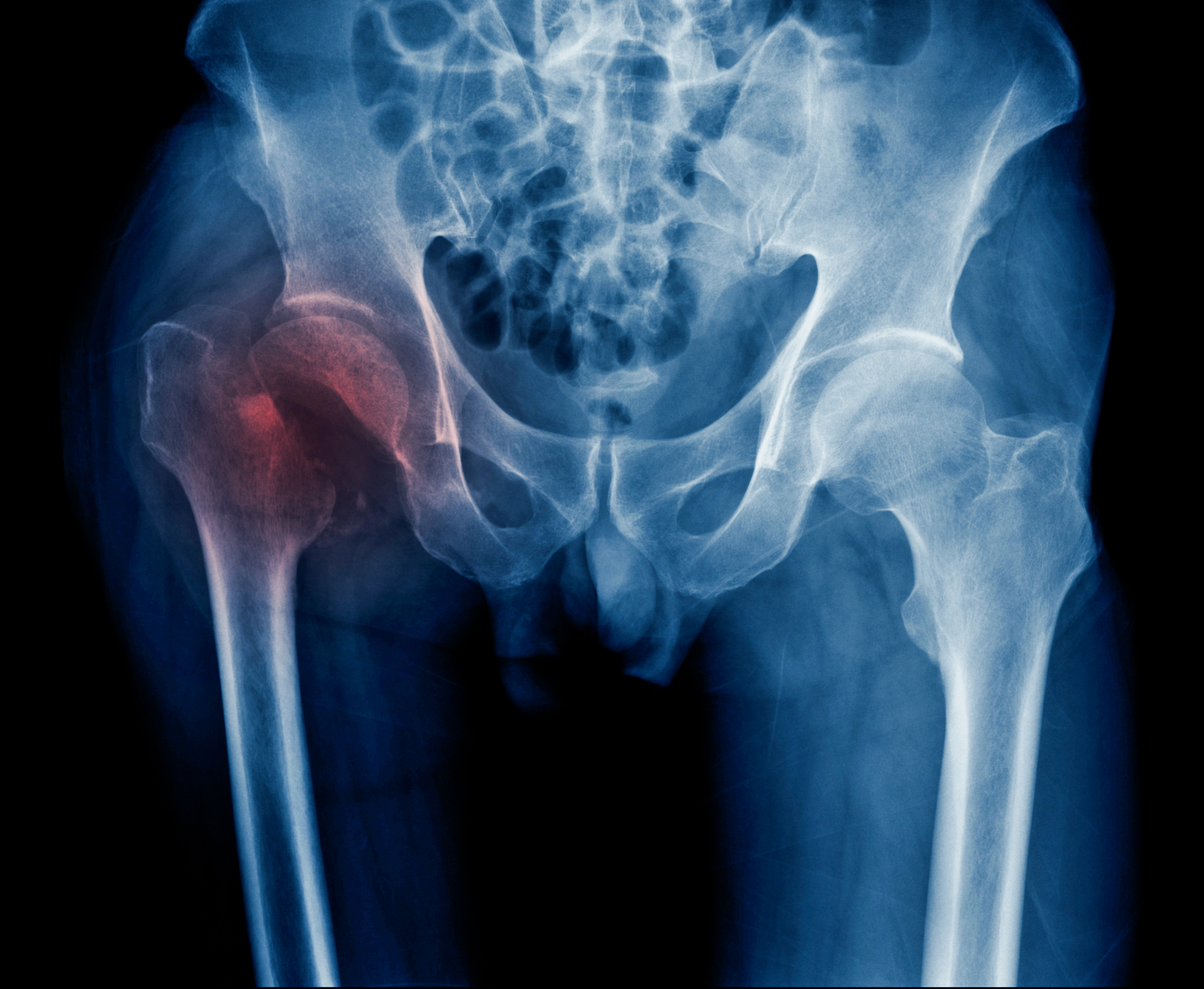 Research Suggests Bone Flexibili...