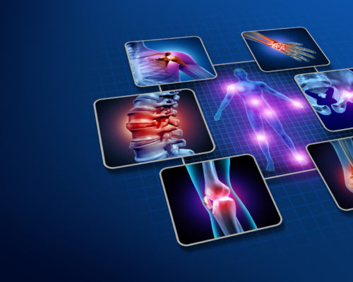 Body joint pain concept as human skeleton and muscle anatomy of the body with a group of sore joints as a painful injury or arthritis illness symbol for health care and medical symptoms with 3D illustration elements.