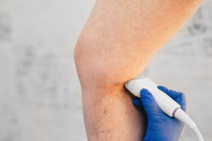 cropped ultrasound exam veins on the leg, vein thrombosis, varicose veins