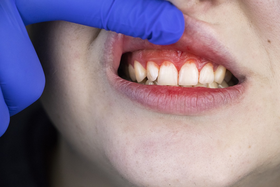 Gum Disease Increases the Risk o...