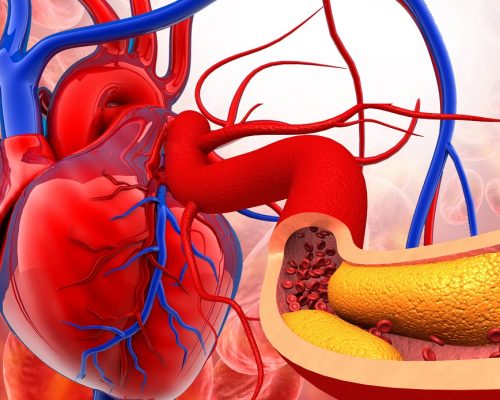 Cholesterol plaque in artery with human heart anatomy. 3d illustration