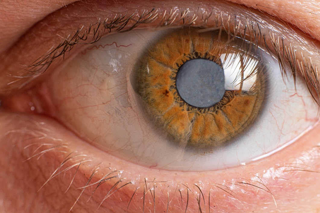 What to Do If You Have Developed Cataracts